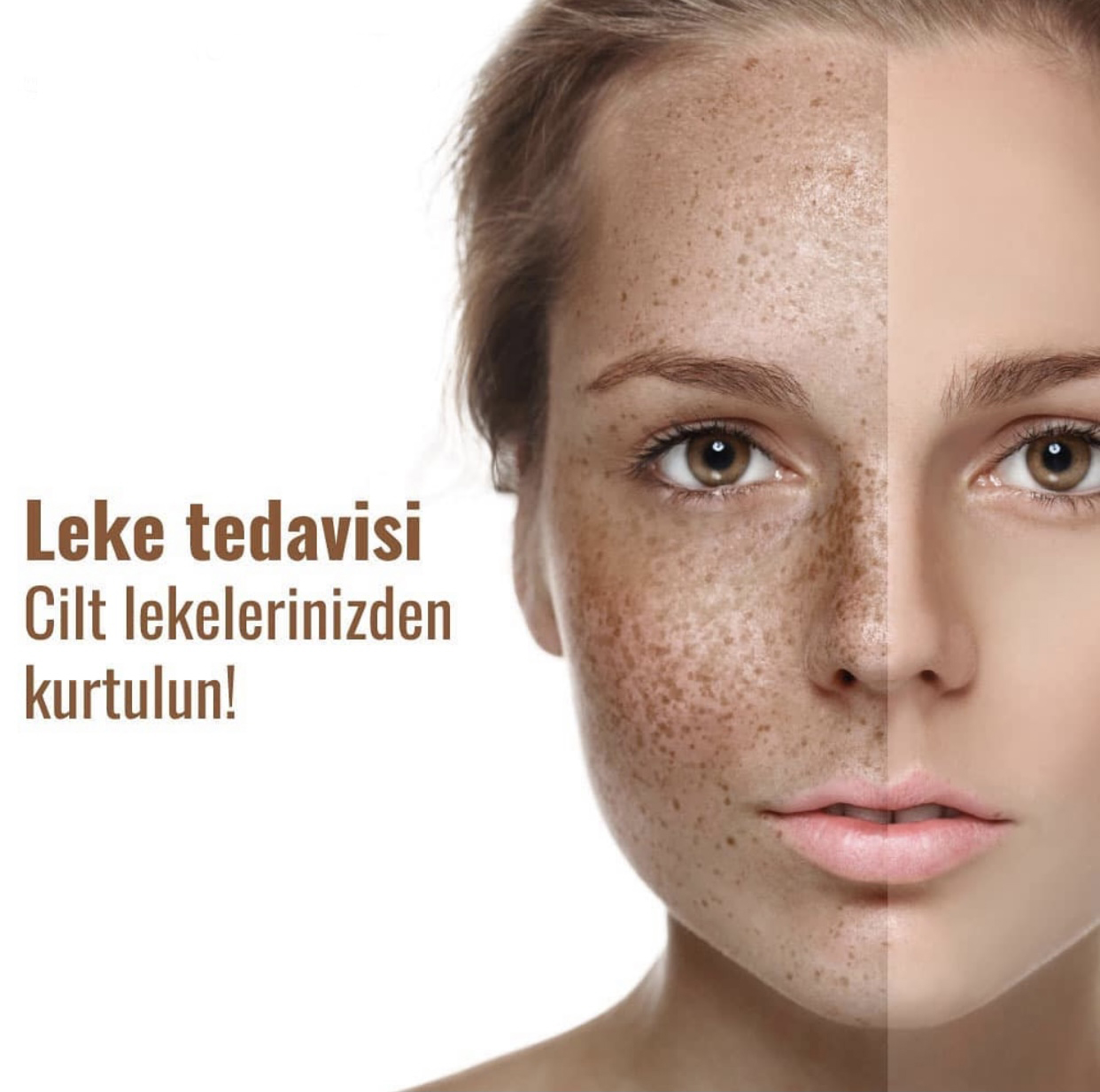 DERMAWHITE LEKE TEDAVİSİ