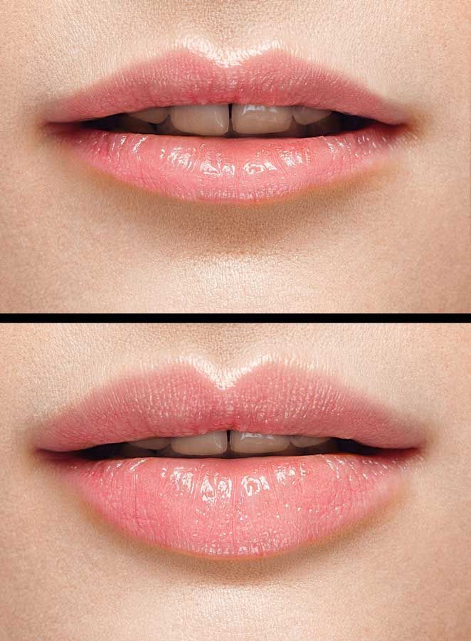 NATURAL LIPS (DUDAK DOLGUSU)